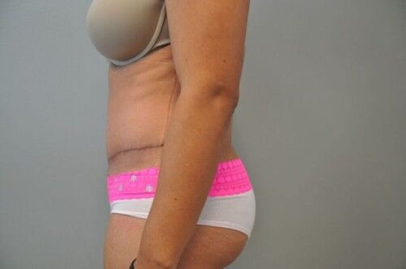 Tummy Tuck Before & After Gallery - Patient 55345644 - Image 10