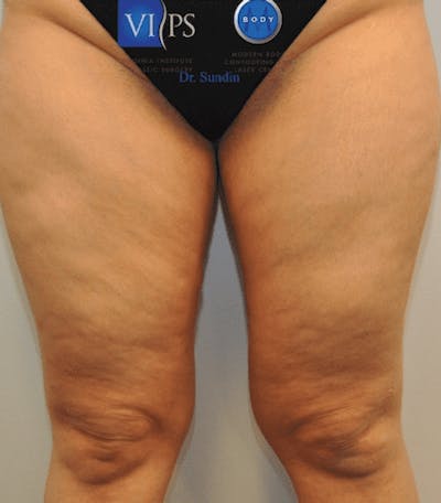 Liposuction Before & After Gallery - Patient 211876611 - Image 1
