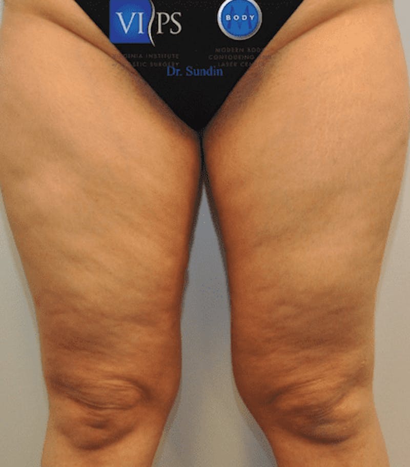 Liposuction Before & After Gallery - Patient 55345652 - Image 1