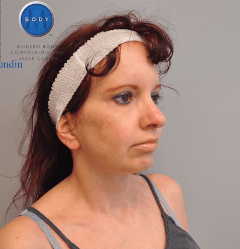 Facelift Before & After Gallery - Patient 55345651 - Image 4