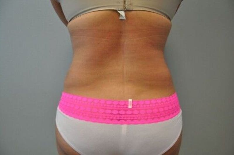 Tummy Tuck Before & After Gallery - Patient 55345644 - Image 12