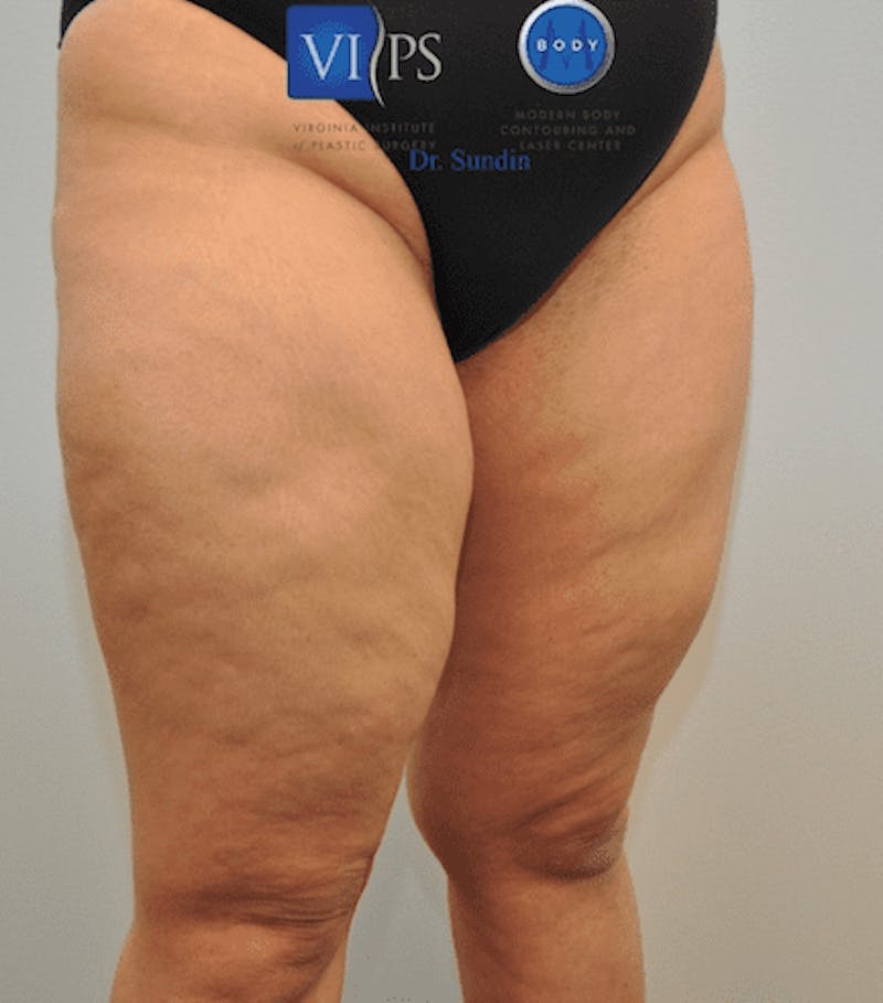 Liposuction Before & After Gallery - Patient 55345652 - Image 3