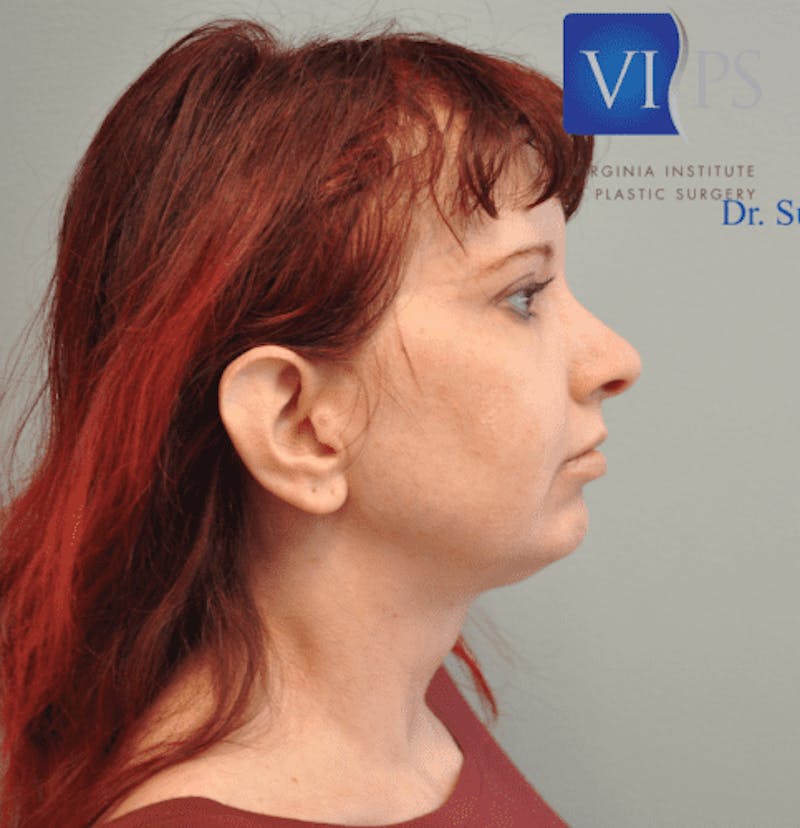 Facelift Before & After Gallery - Patient 55345651 - Image 5