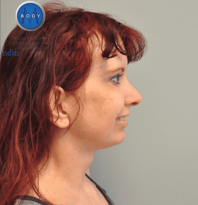 Facelift Before & After Gallery - Patient 55345651 - Image 6