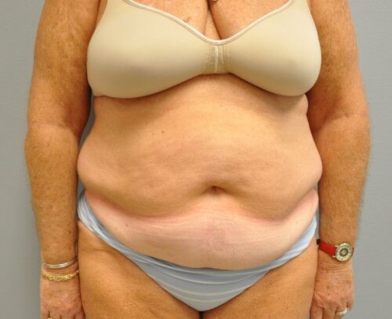 Tummy Tuck Before & After Gallery - Patient 55345654 - Image 1