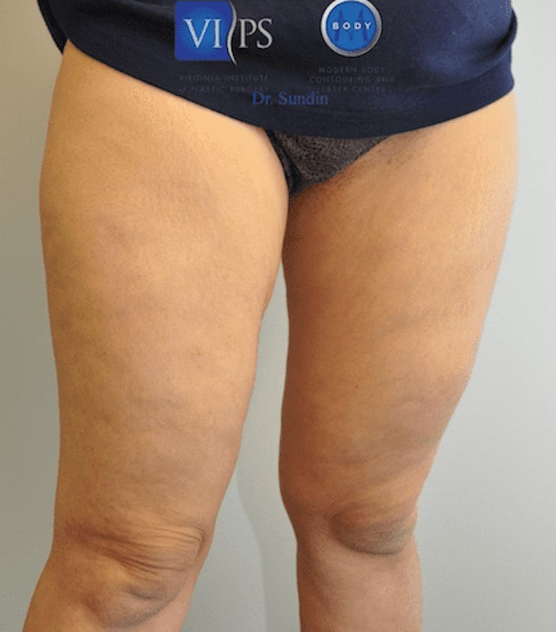 Liposuction Before & After Gallery - Patient 211876611 - Image 4