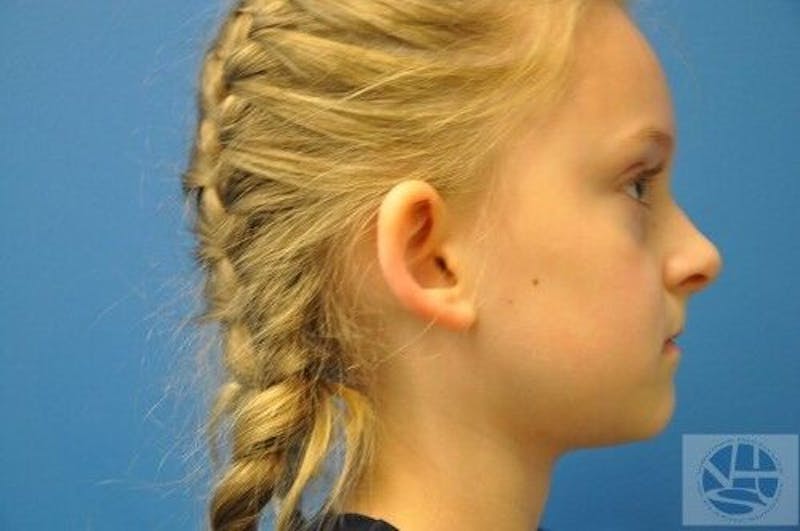Otoplasty Before & After Gallery - Patient 55345650 - Image 5