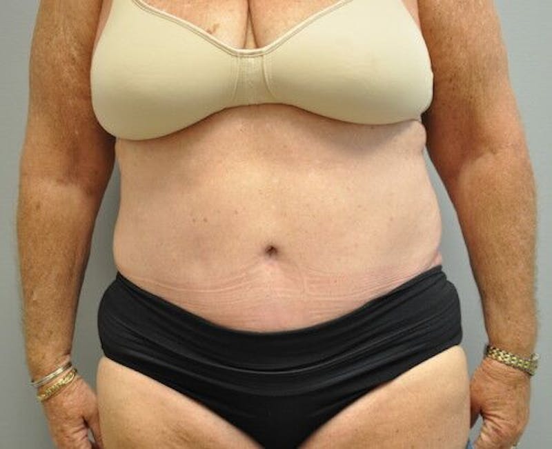 Tummy Tuck Before & After Gallery - Patient 55345654 - Image 2