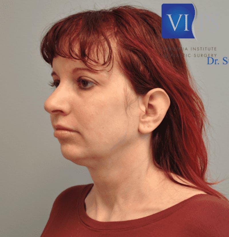 Facelift Before & After Gallery - Patient 55345651 - Image 7