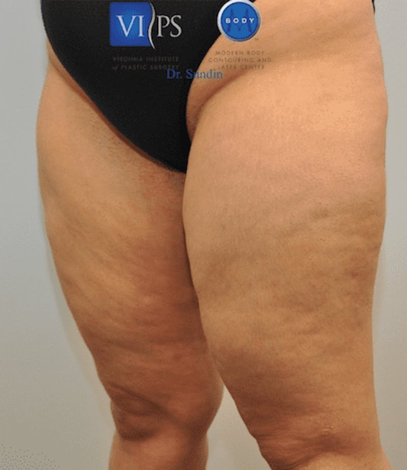 Liposuction Before & After Gallery - Patient 211876611 - Image 5