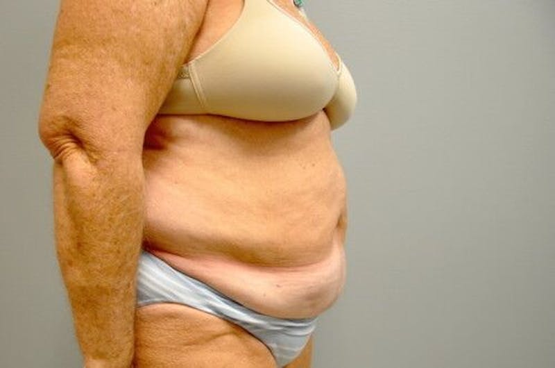 Tummy Tuck Before & After Gallery - Patient 55345654 - Image 3
