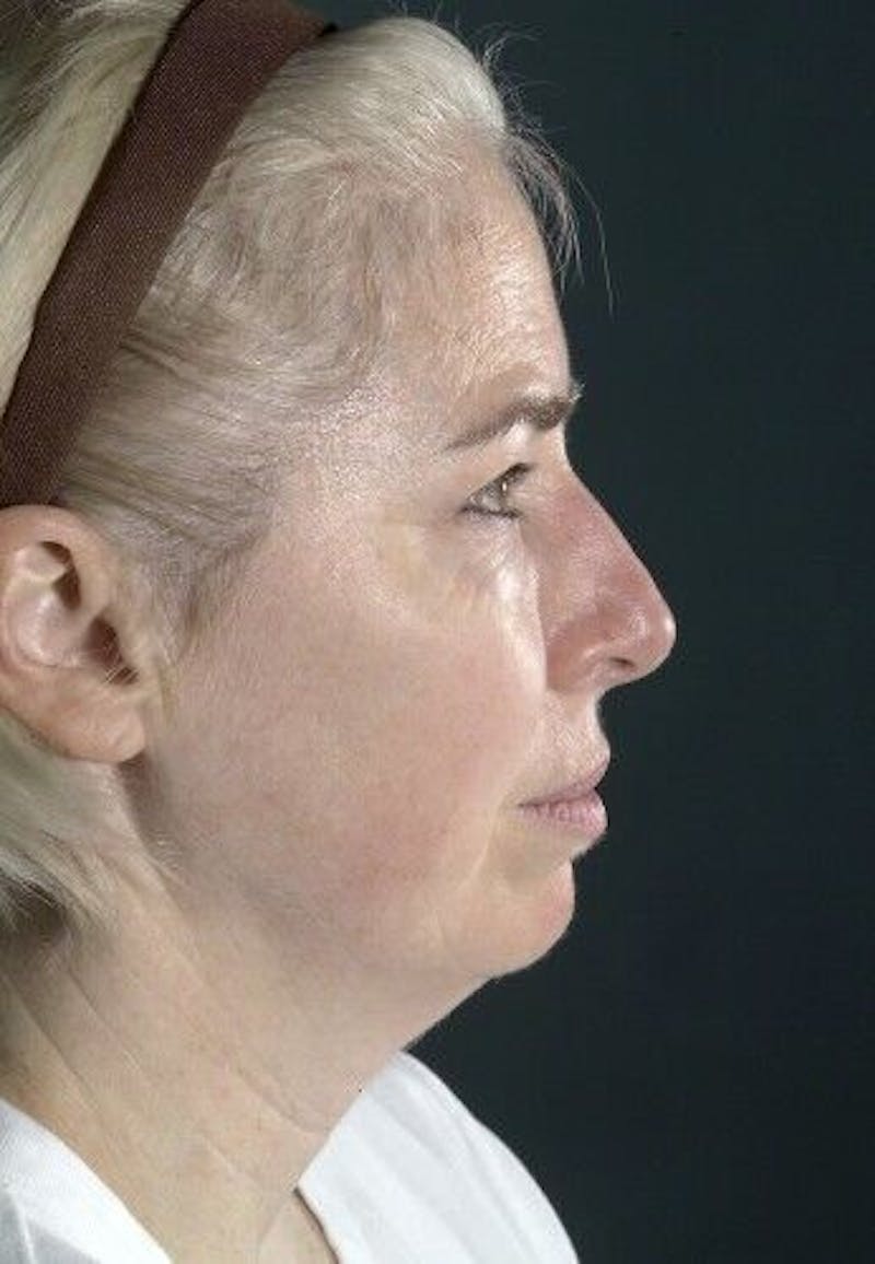 Neck Lift Before & After Gallery - Patient 55345653 - Image 1