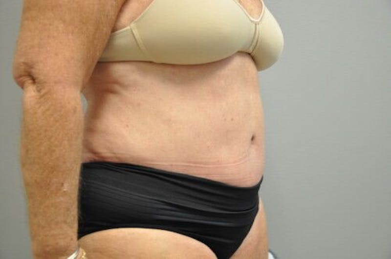 Tummy Tuck Before & After Gallery - Patient 55345654 - Image 4