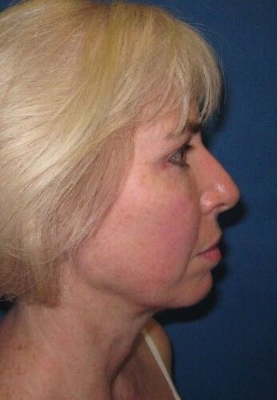 Neck Lift Before & After Gallery - Patient 55345653 - Image 2