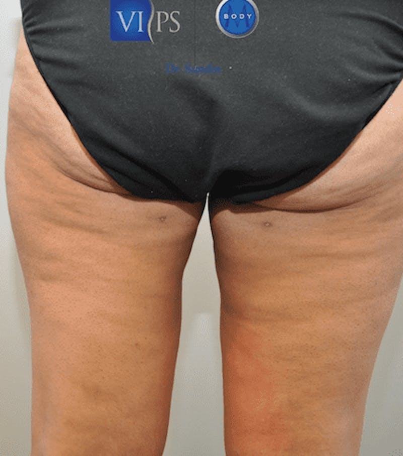 Liposuction Before & After Gallery - Patient 55345652 - Image 7