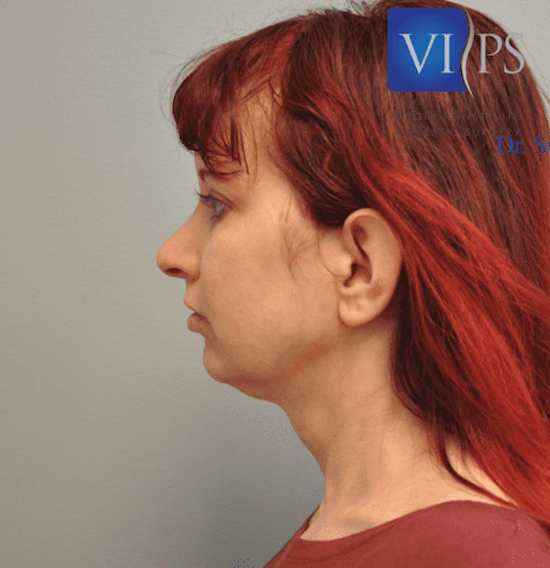 Facelift Before & After Gallery - Patient 55345651 - Image 9