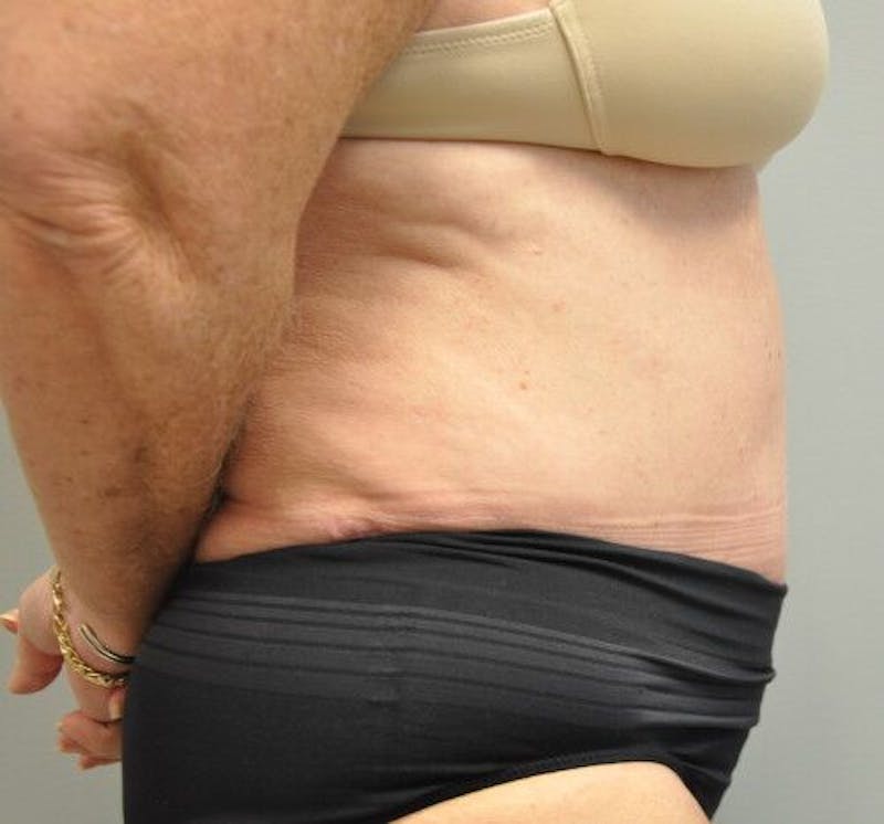 Tummy Tuck Gallery - Patient 55345654 - Image 5