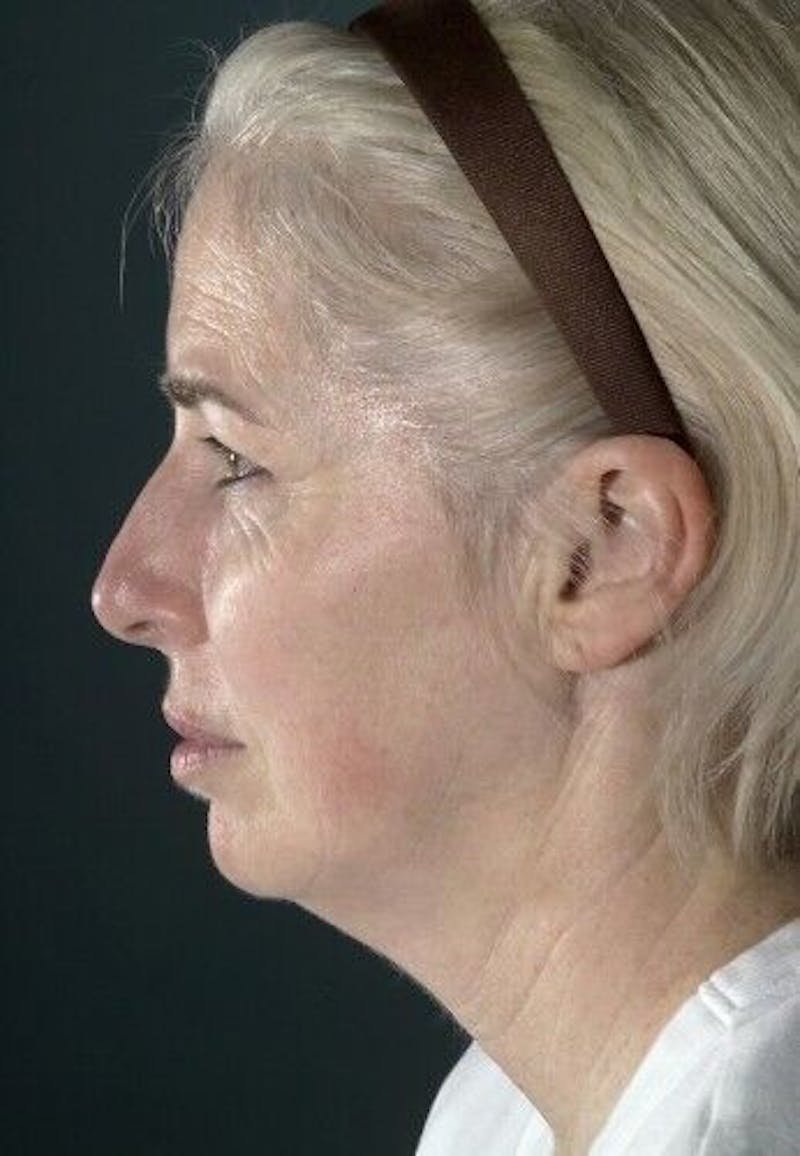 Neck Lift Before & After Gallery - Patient 55345653 - Image 5