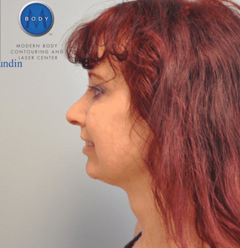 Facelift Before & After Gallery - Patient 55345651 - Image 10