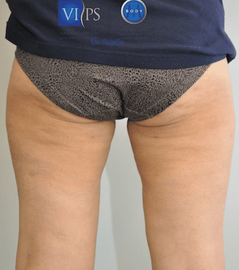 Liposuction Before & After Gallery - Patient 55345652 - Image 8