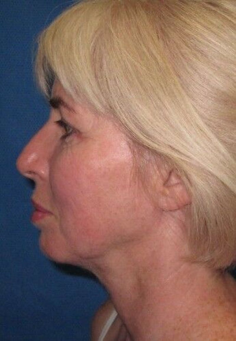 Neck Lift Before & After Gallery - Patient 55345653 - Image 6