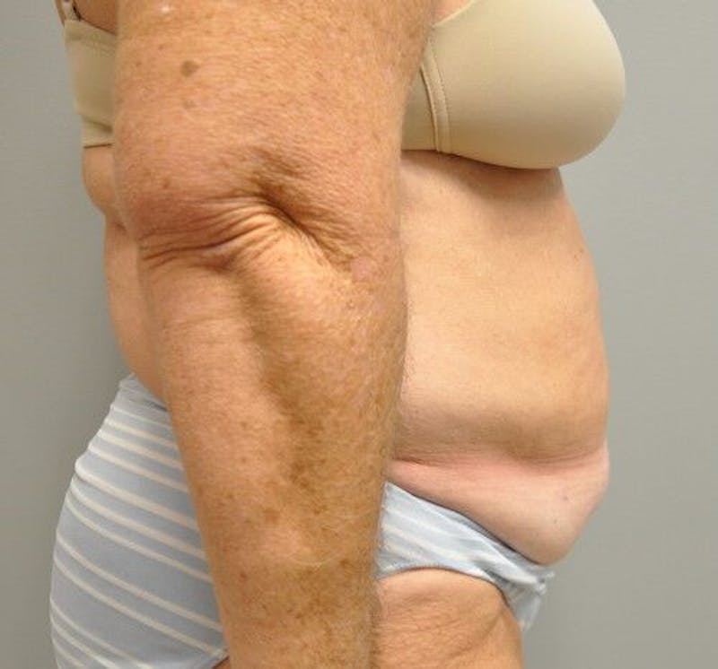 Tummy Tuck Before & After Gallery - Patient 55345654 - Image 6
