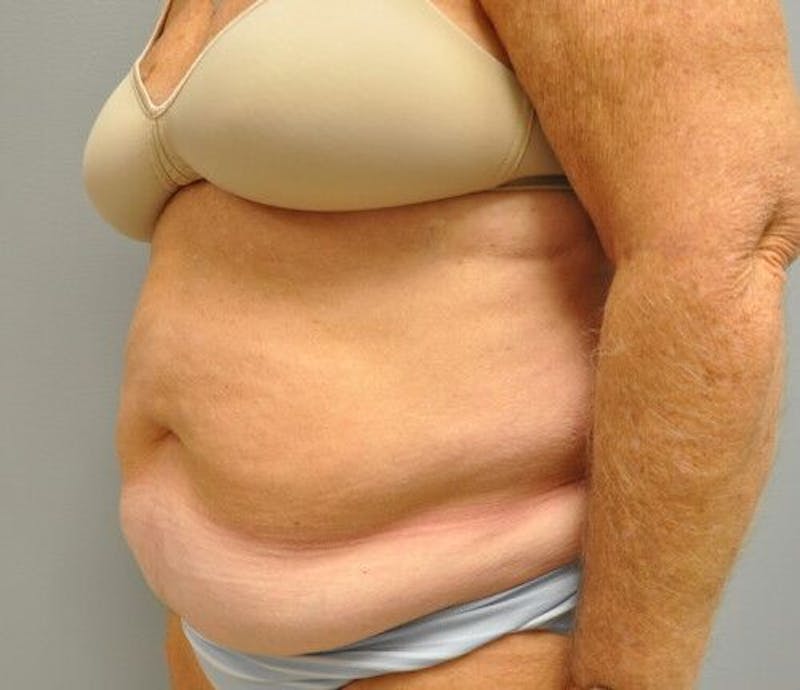 Tummy Tuck Before & After Gallery - Patient 55345654 - Image 7