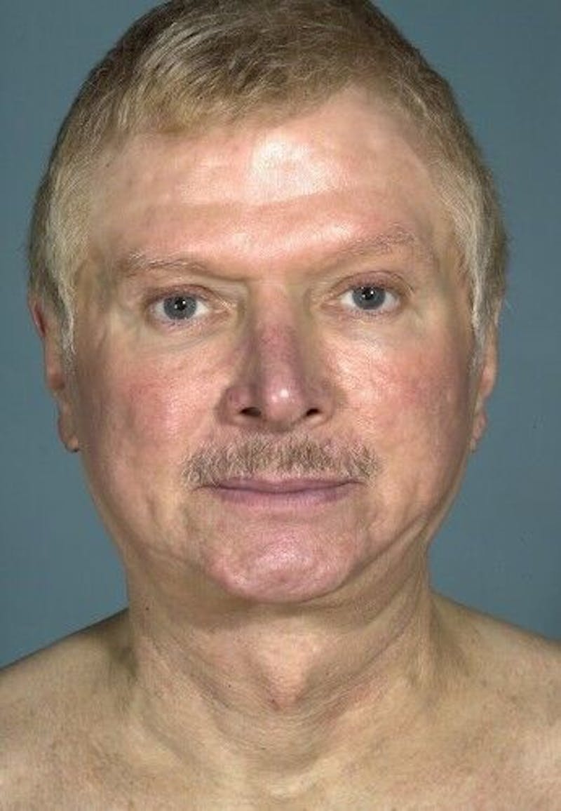 Neck Lift Before & After Gallery - Patient 55345658 - Image 5