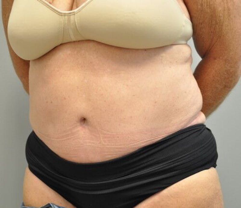 Tummy Tuck Gallery - Patient 55345654 - Image 8