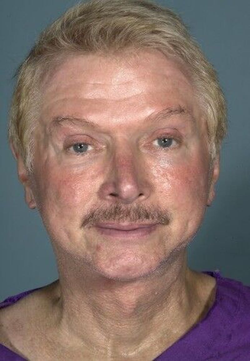 Neck Lift Before & After Gallery - Patient 55345658 - Image 6