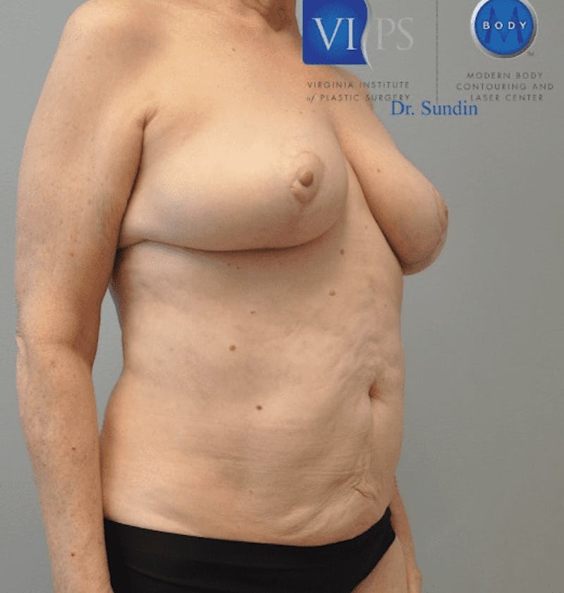 Liposuction Before & After Gallery - Patient 55345660 - Image 2