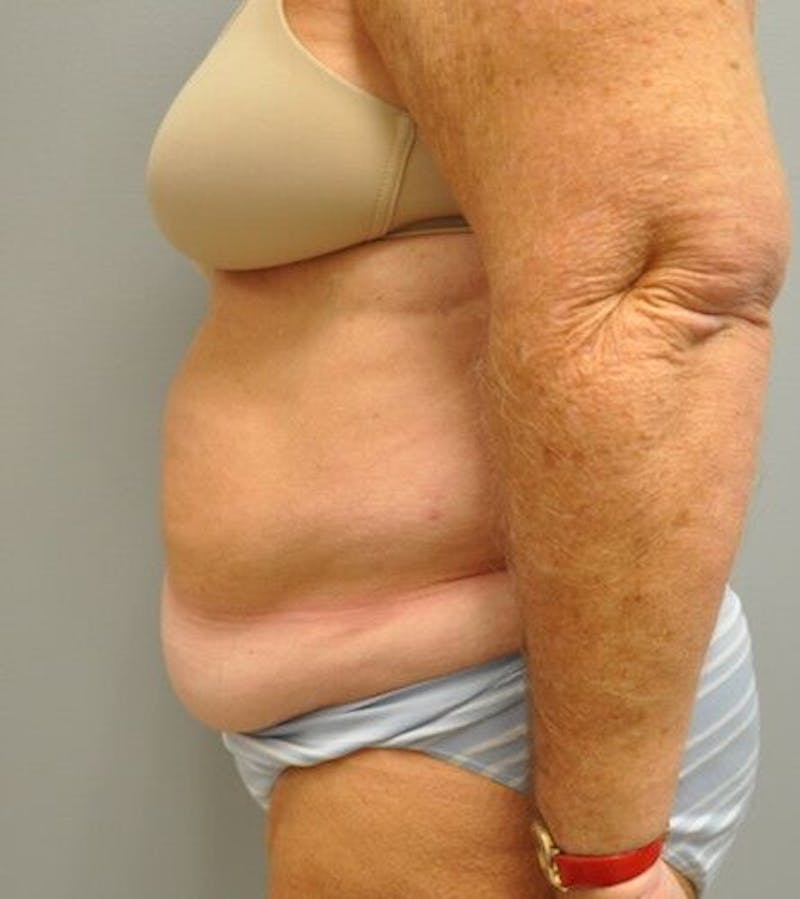 Tummy Tuck Gallery - Patient 55345654 - Image 9