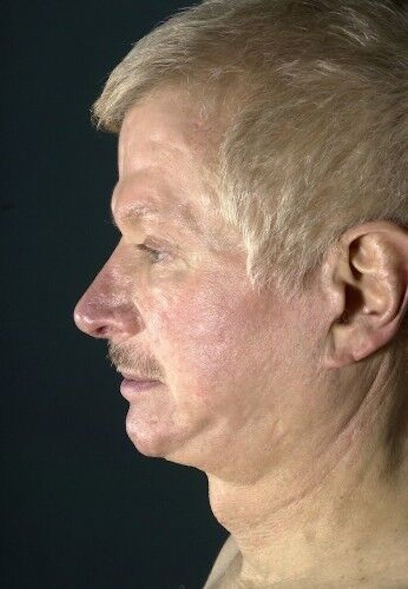 Neck Lift Before & After Gallery - Patient 55345658 - Image 3