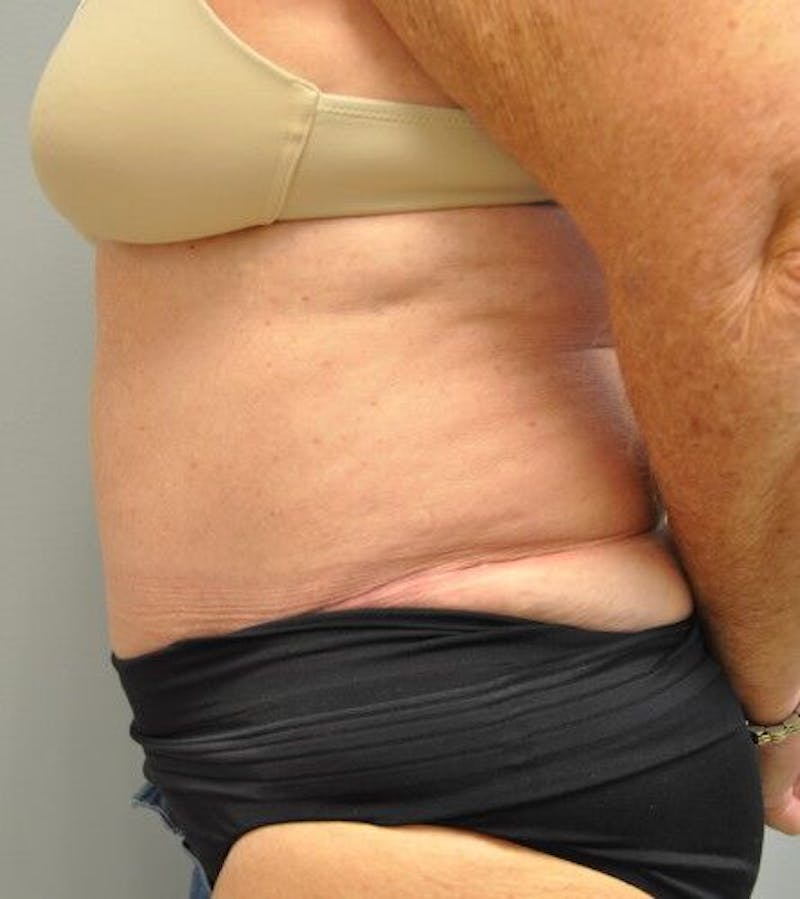 Tummy Tuck Before & After Gallery - Patient 55345654 - Image 10