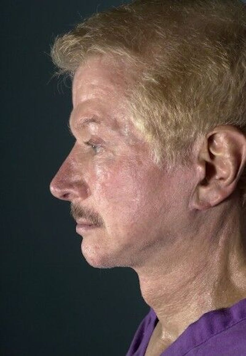 Neck Lift Before & After Gallery - Patient 55345658 - Image 4