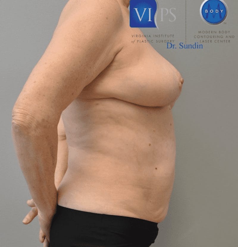 Liposuction Before & After Gallery - Patient 55345660 - Image 4