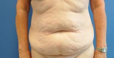 Tummy Tuck Before & After Gallery - Patient 55345662 - Image 1