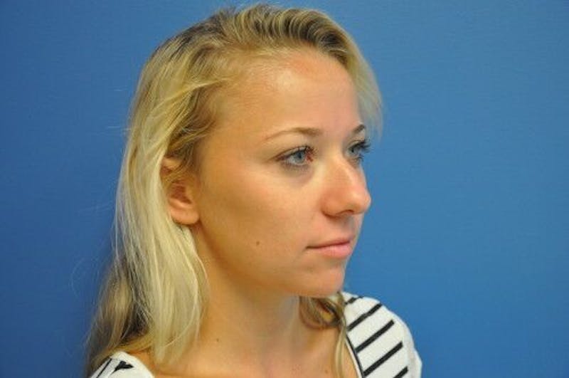 Rhinoplasty Before & After Gallery - Patient 55345659 - Image 3