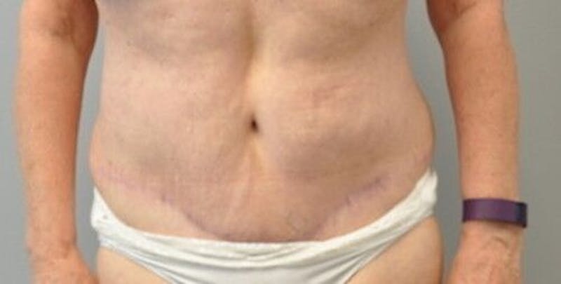 Tummy Tuck Before & After Gallery - Patient 55345662 - Image 2