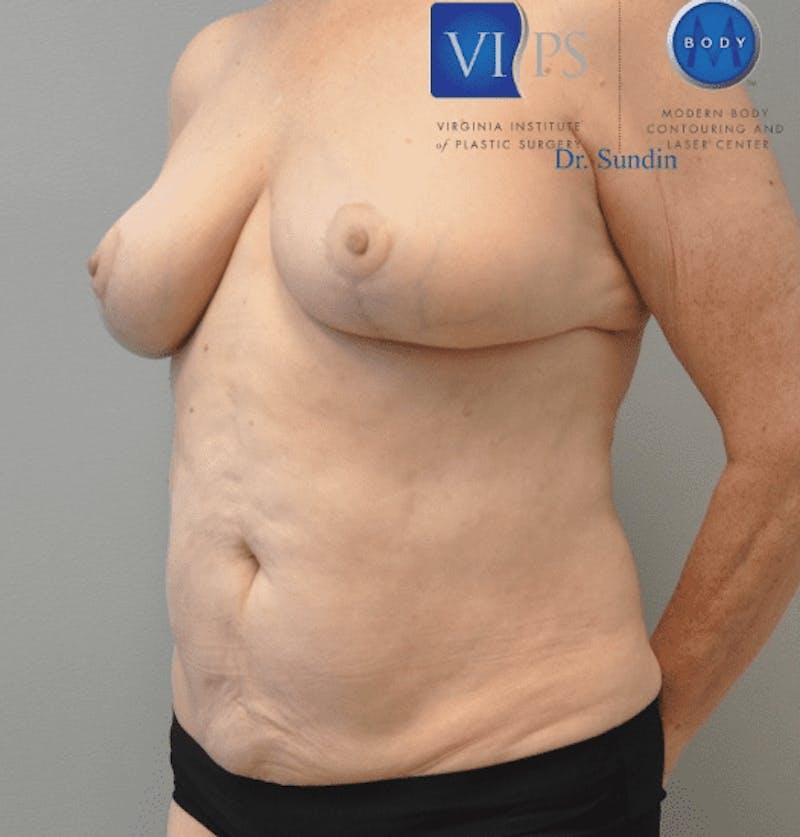 Liposuction Before & After Gallery - Patient 55345660 - Image 6
