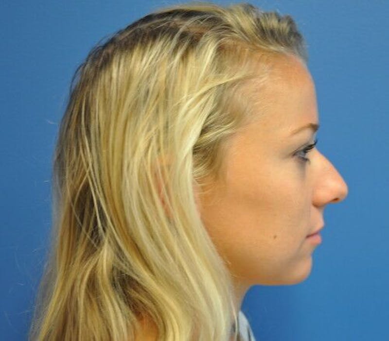 Rhinoplasty Before & After Gallery - Patient 55345659 - Image 5