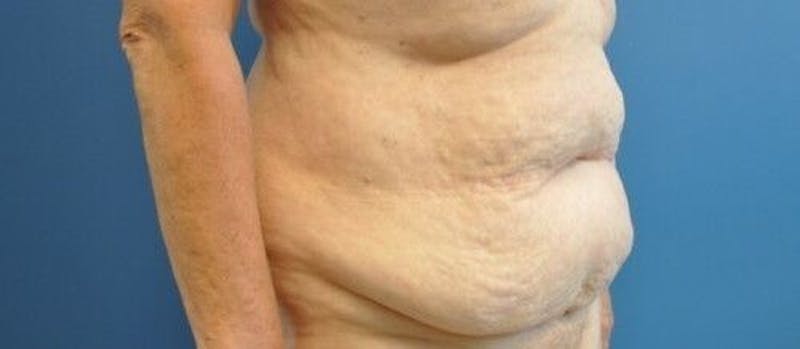 Tummy Tuck Before & After Gallery - Patient 55345662 - Image 3