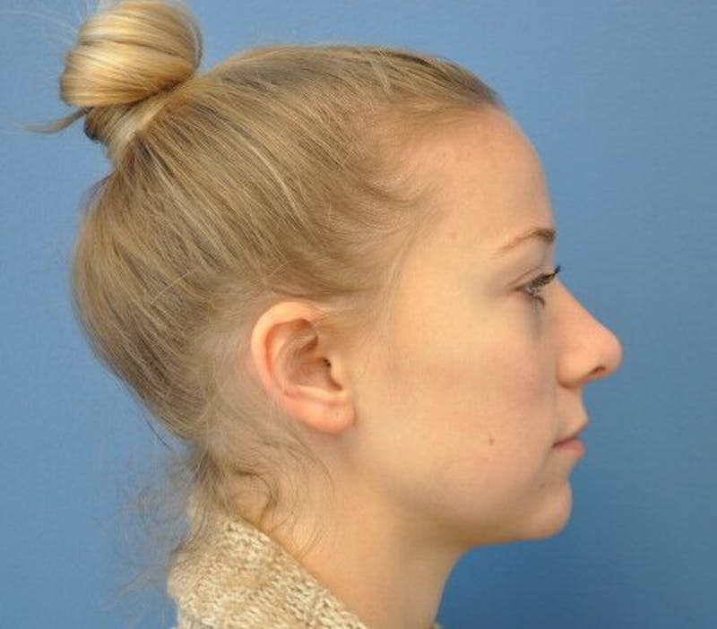 Rhinoplasty Before & After Gallery - Patient 55345659 - Image 6