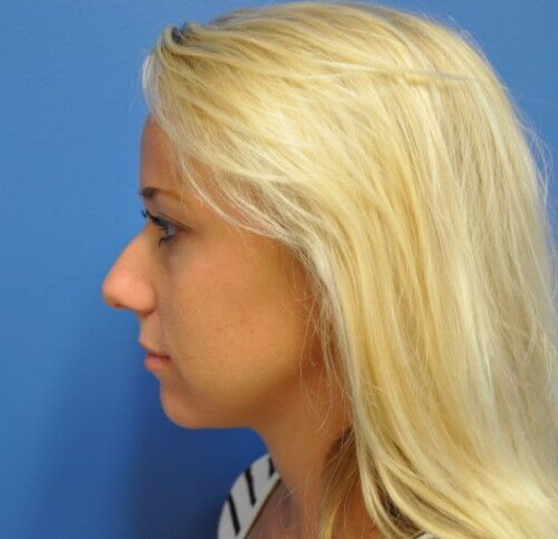 Rhinoplasty Before & After Gallery - Patient 55345659 - Image 7