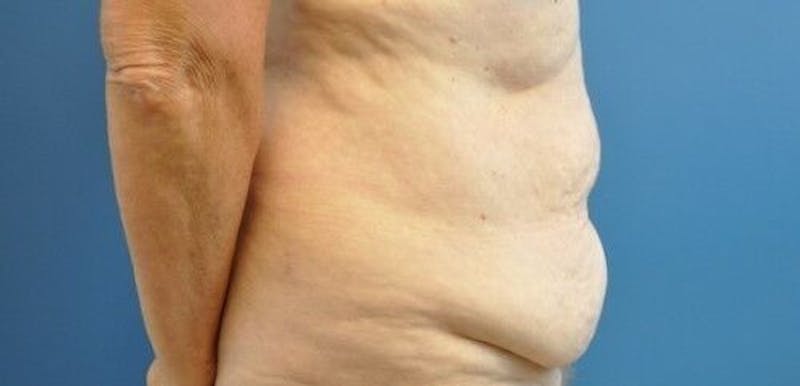 Tummy Tuck Before & After Gallery - Patient 55345662 - Image 5