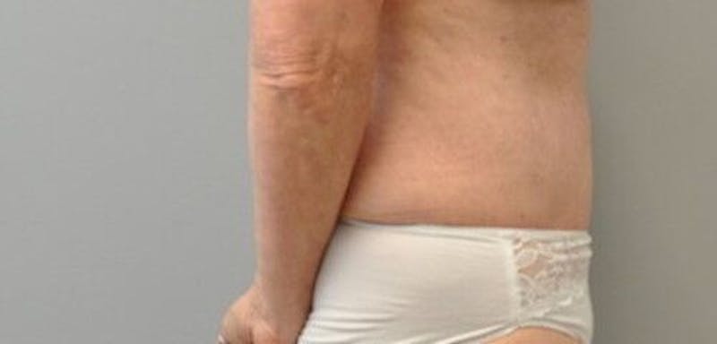 Tummy Tuck Before & After Gallery - Patient 55345662 - Image 6