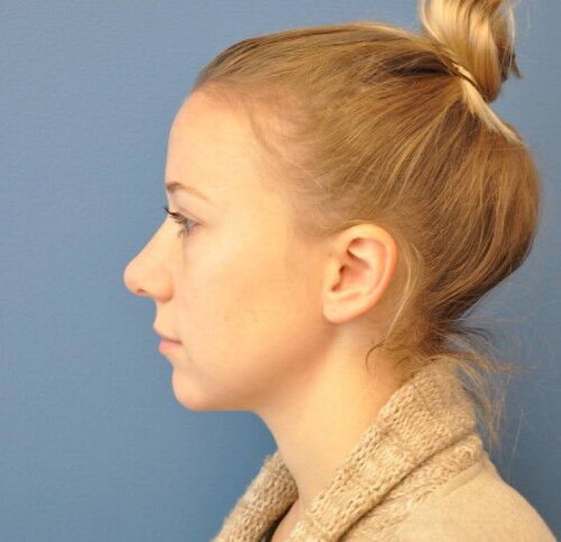Rhinoplasty Before & After Gallery - Patient 55345659 - Image 8