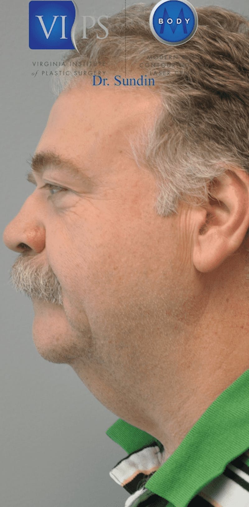 Neck Lift Before & After Gallery - Patient 55345661 - Image 5