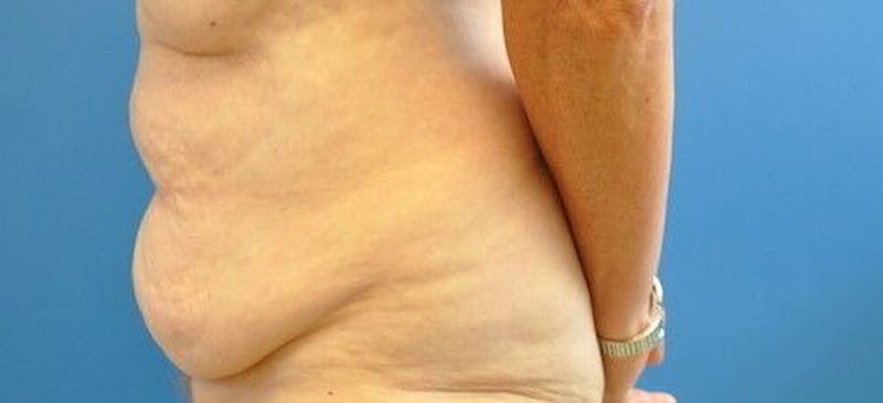 Tummy Tuck Before & After Gallery - Patient 55345662 - Image 9