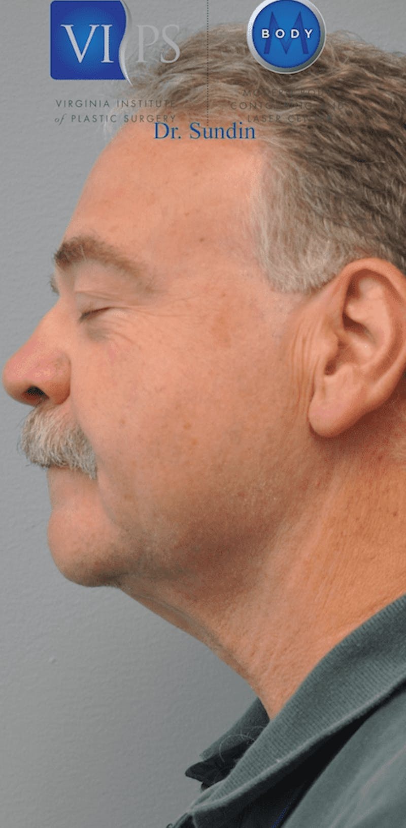 Neck Lift Before & After Gallery - Patient 55345661 - Image 6